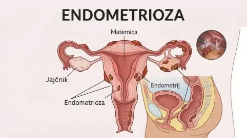endometrioza